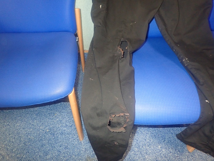 Trousers with holes burnt through material